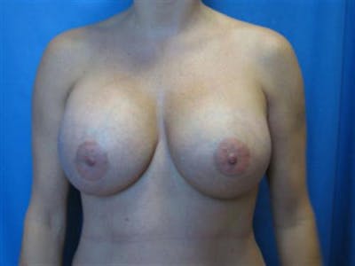 Breast Augmentation Before & After Gallery - Patient 448579 - Image 2