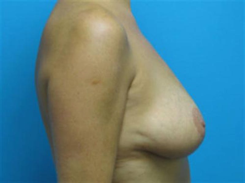 Breast Augmentation Before & After Gallery - Patient 448579 - Image 3