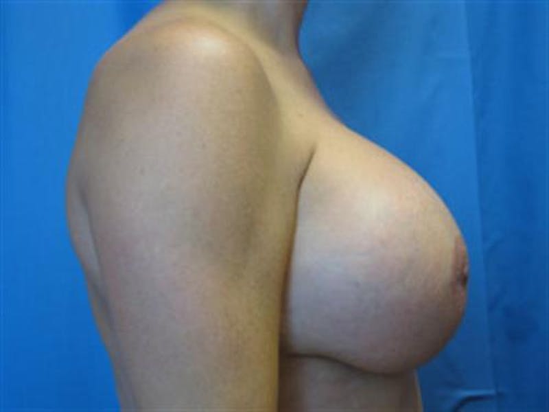 Breast Augmentation Before & After Gallery - Patient 448579 - Image 4