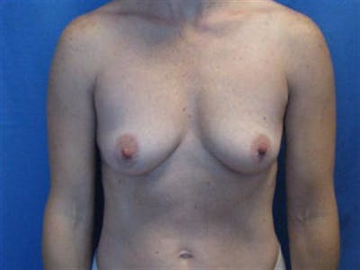 Breast Augmentation Before & After Gallery - Patient 119243 - Image 1