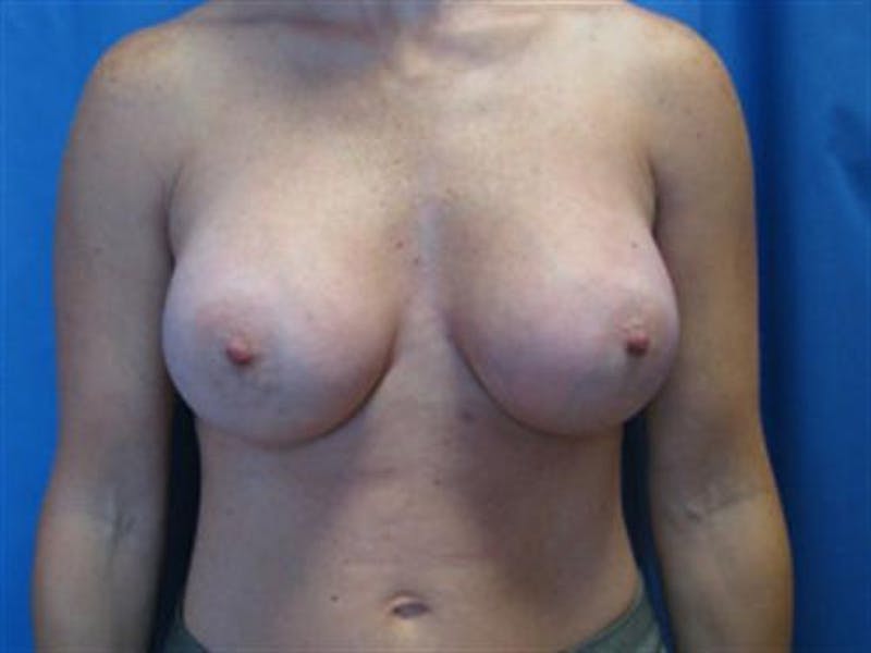 Breast Augmentation Before & After Gallery - Patient 119243 - Image 2