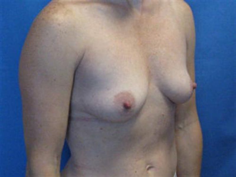 Breast Augmentation Before & After Gallery - Patient 119243 - Image 3