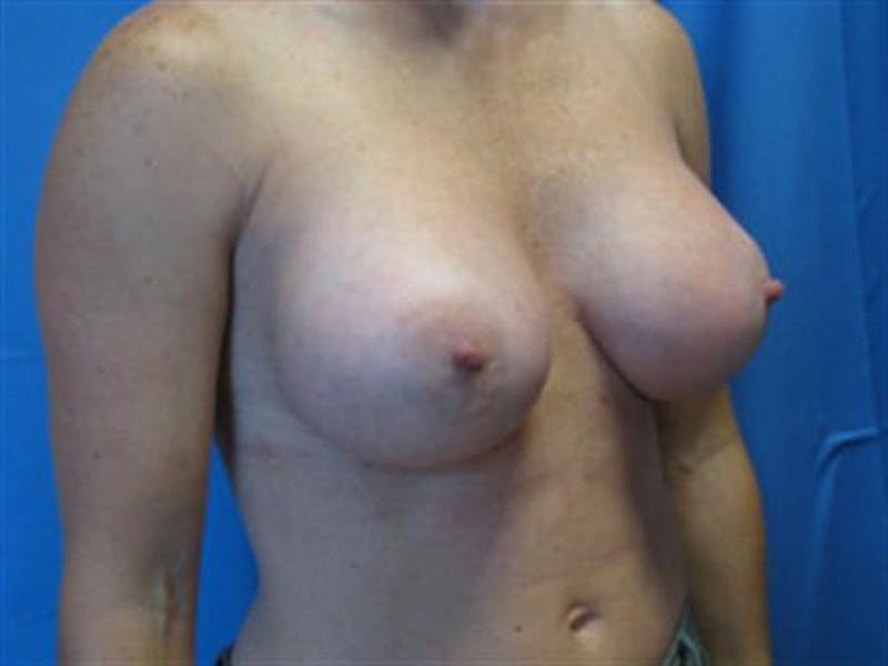 Breast Augmentation Before & After Gallery - Patient 119243 - Image 4