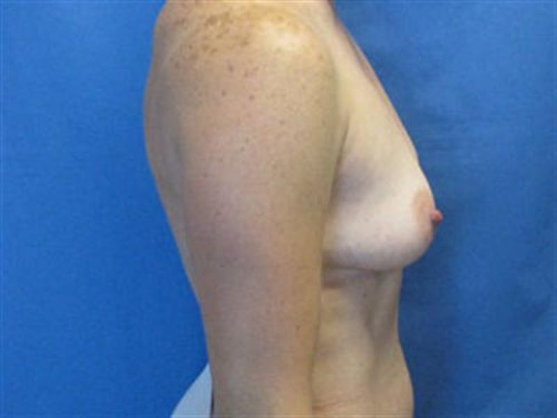 Breast Augmentation Before & After Gallery - Patient 119243 - Image 5