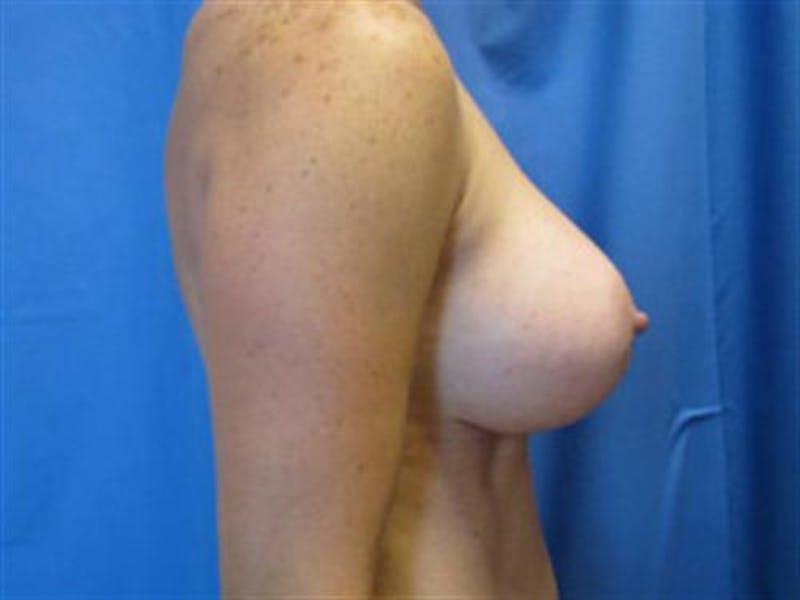 Breast Augmentation Before & After Gallery - Patient 119243 - Image 6