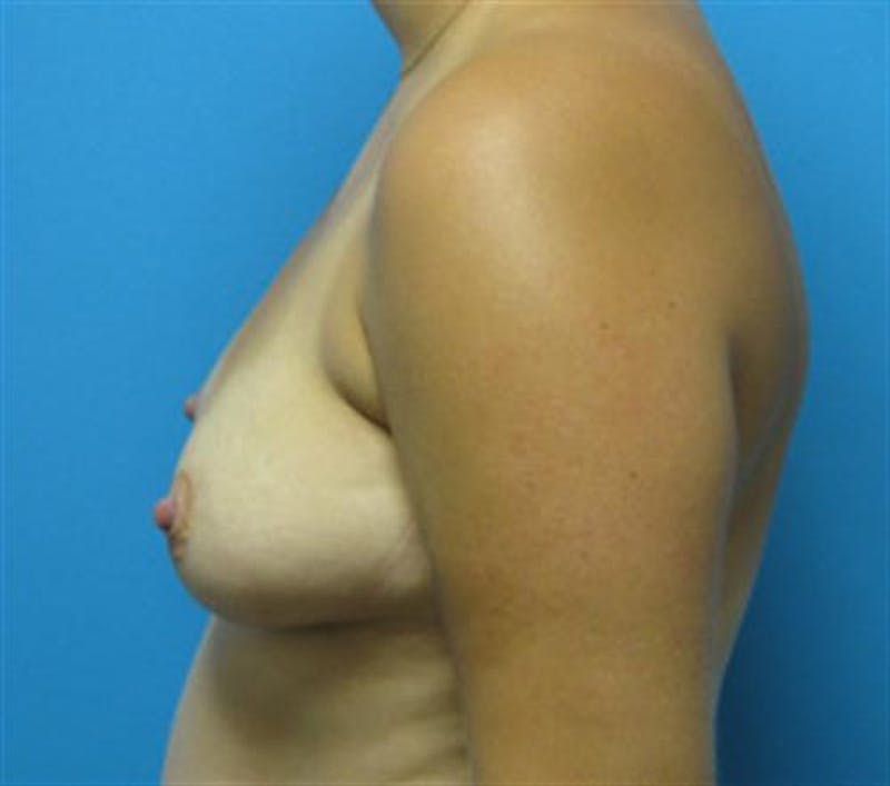 Breast Augmentation Before & After Gallery - Patient 362534 - Image 5