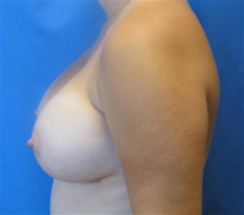 Breast Augmentation Before & After Gallery - Patient 362534 - Image 6