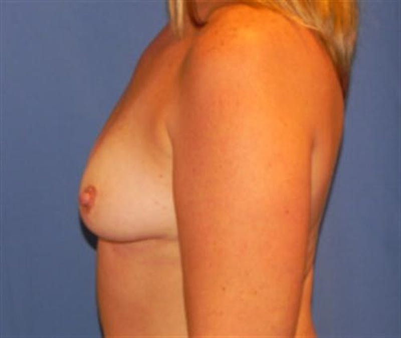 Breast Augmentation Before & After Gallery - Patient 606484 - Image 5