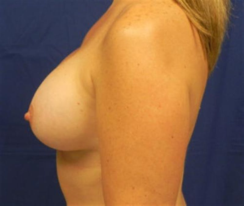 Breast Augmentation Before & After Gallery - Patient 606484 - Image 6