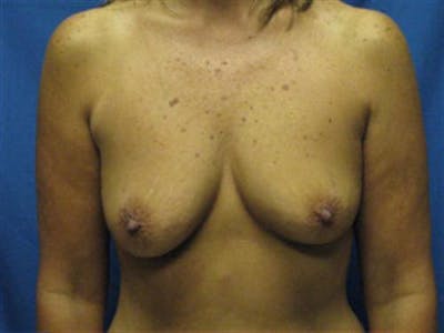 Breast Augmentation Before & After Gallery - Patient 342386 - Image 1