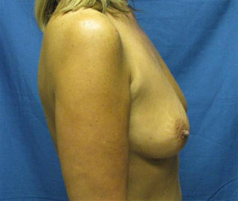 Breast Augmentation Before & After Gallery - Patient 342386 - Image 3