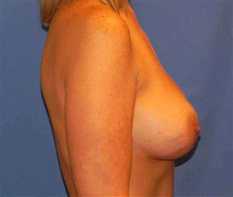 Breast Augmentation Before & After Gallery - Patient 342386 - Image 4