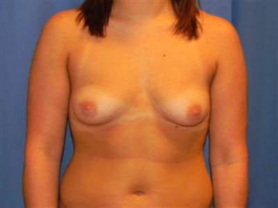 Breast Augmentation Before & After Gallery - Patient 157264 - Image 1