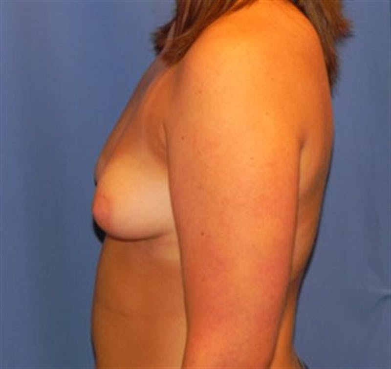 Breast Augmentation Before & After Gallery - Patient 157264 - Image 3