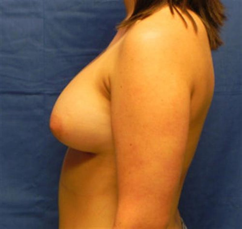 Breast Augmentation Before & After Gallery - Patient 157264 - Image 4