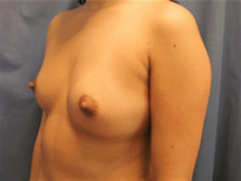 Breast Augmentation Before & After Gallery - Patient 427154 - Image 3