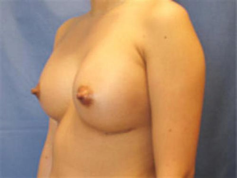 Breast Augmentation Before & After Gallery - Patient 427154 - Image 4