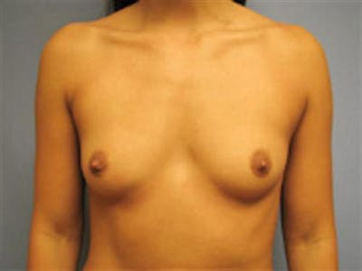 Breast Augmentation Before & After Gallery - Patient 923219 - Image 1