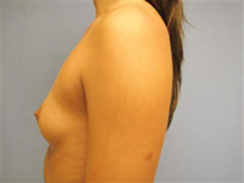 Breast Augmentation Before & After Gallery - Patient 923219 - Image 3