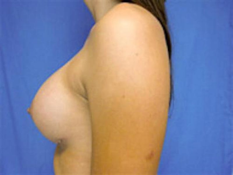 Breast Augmentation Before & After Gallery - Patient 923219 - Image 4