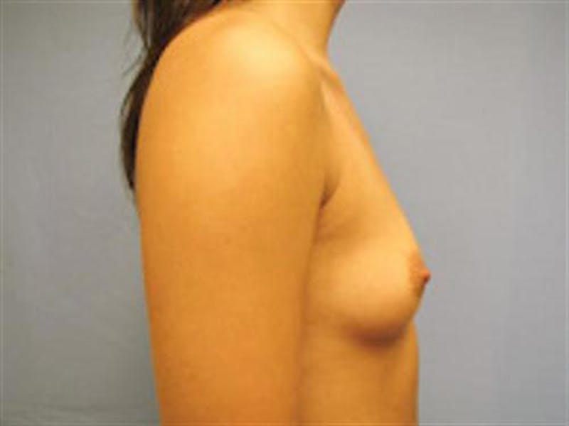 Breast Augmentation Before & After Gallery - Patient 923219 - Image 5