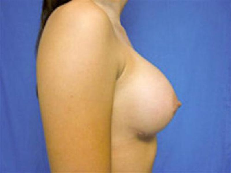 Breast Augmentation Before & After Gallery - Patient 923219 - Image 6