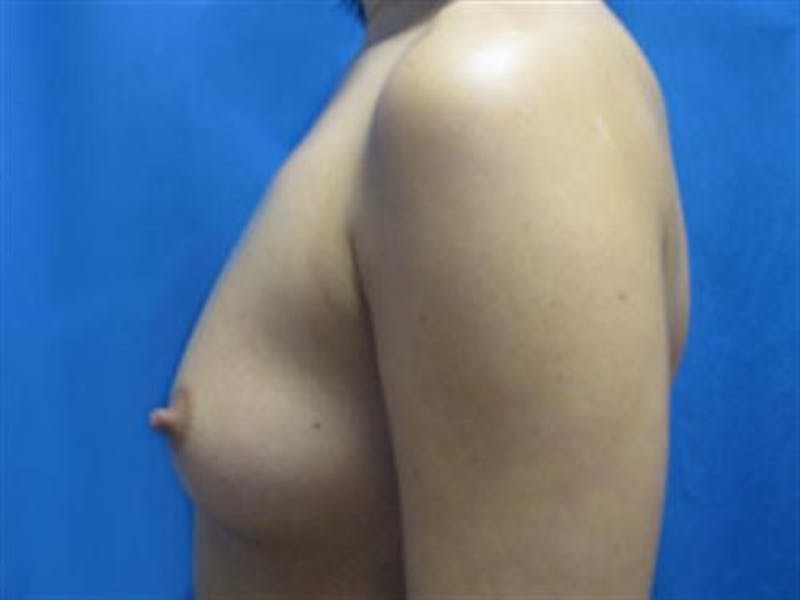 Breast Augmentation Before & After Gallery - Patient 398512 - Image 3