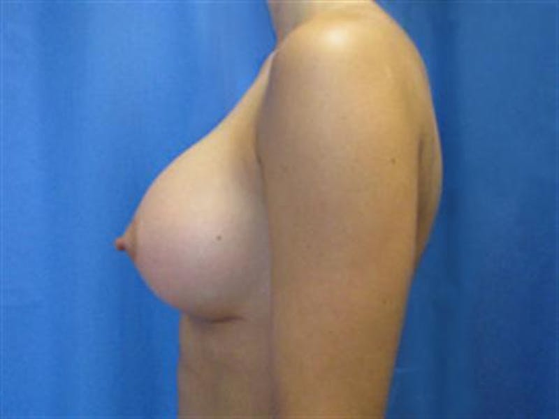 Breast Augmentation Before & After Gallery - Patient 398512 - Image 4