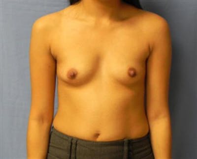 Breast Augmentation Before & After Gallery - Patient 180399 - Image 1