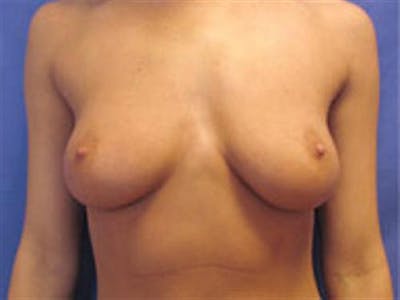 Breast Augmentation Before & After Gallery - Patient 519518 - Image 1