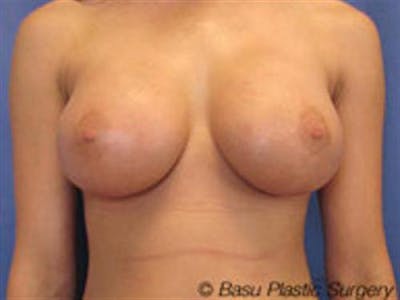 Breast Augmentation Before & After Gallery - Patient 519518 - Image 2