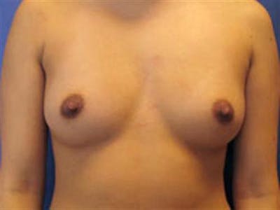 Breast Augmentation Before & After Gallery - Patient 339995 - Image 1