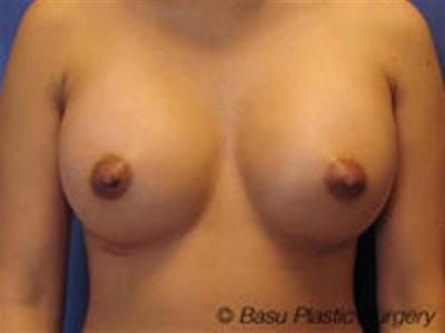 Breast Augmentation Before & After Gallery - Patient 339995 - Image 2