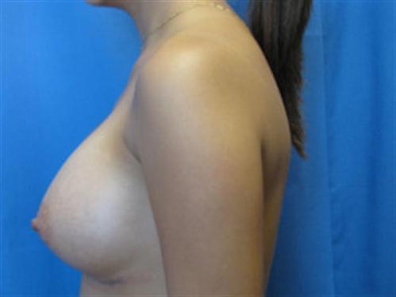 Breast Augmentation Before & After Gallery - Patient 279696 - Image 4
