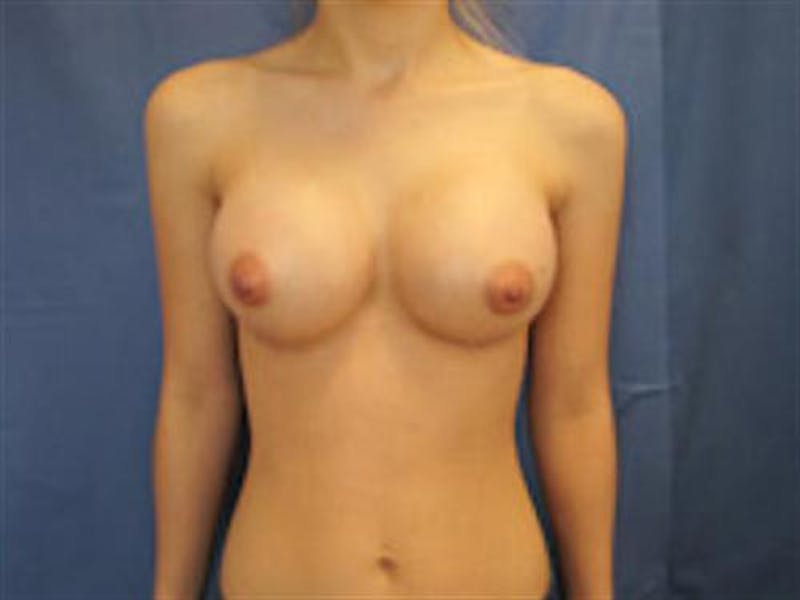 Breast Augmentation Before & After Gallery - Patient 336520 - Image 2