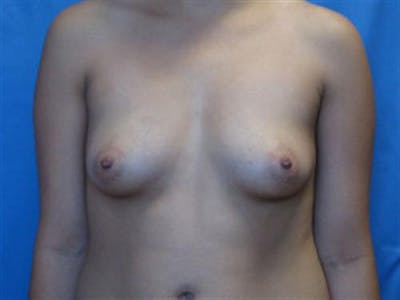 Breast Augmentation Before & After Gallery - Patient 148655 - Image 1