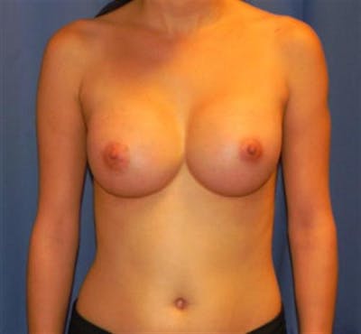 Breast Augmentation Before & After Gallery - Patient 422856 - Image 2