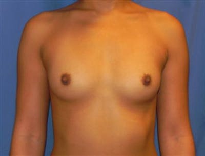 Breast Augmentation Before & After Gallery - Patient 689391 - Image 1