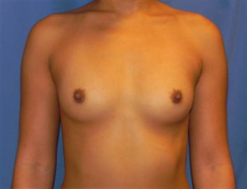 Breast Augmentation Before & After Gallery - Patient 689391 - Image 1