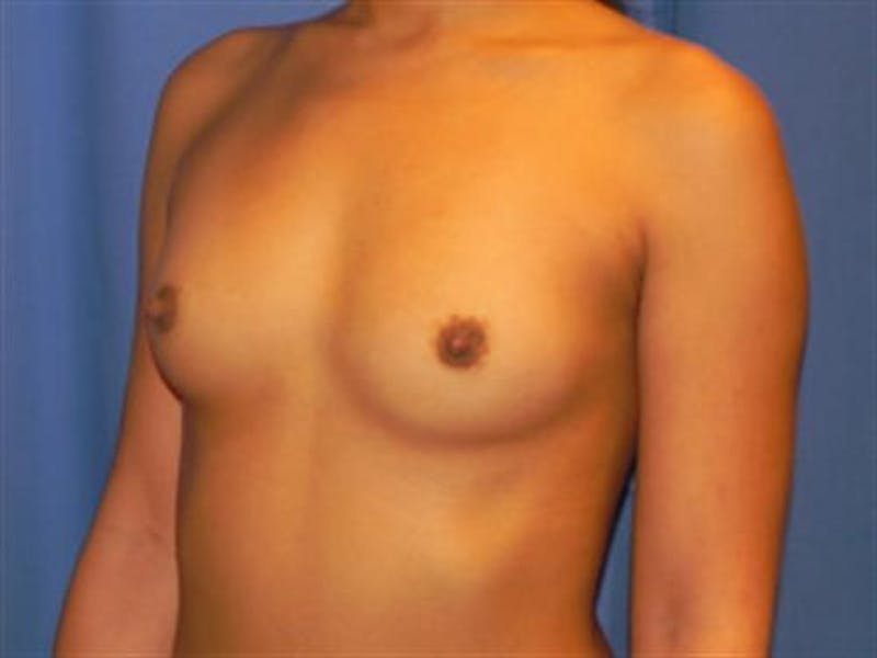 Breast Augmentation Before & After Gallery - Patient 689391 - Image 3