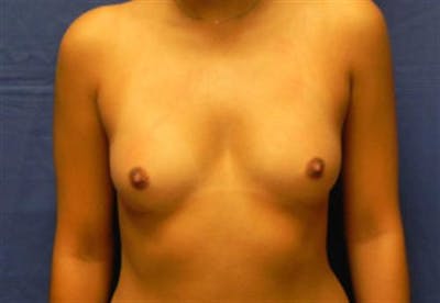 Breast Augmentation Before & After Gallery - Patient 354657 - Image 1