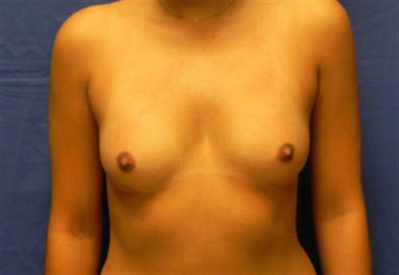 Breast Augmentation Before & After Gallery - Patient 354657 - Image 1