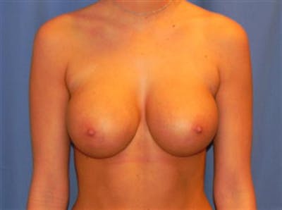 Breast Augmentation Before & After Gallery - Patient 154968 - Image 2