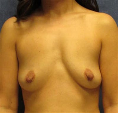 Breast Augmentation Before & After Gallery - Patient 351270 - Image 1