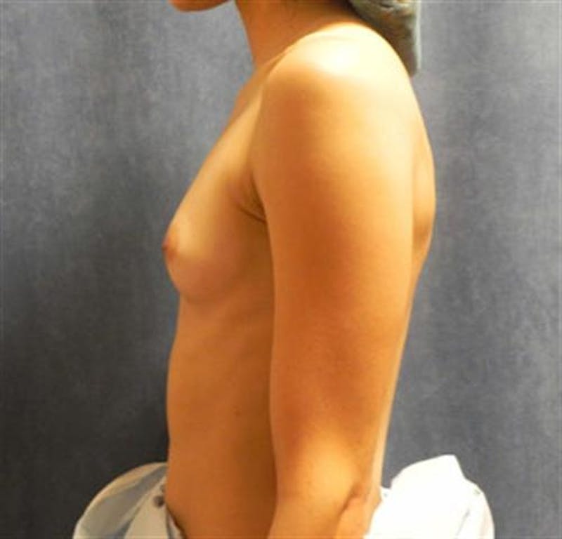 Breast Augmentation Before & After Gallery - Patient 369406 - Image 3