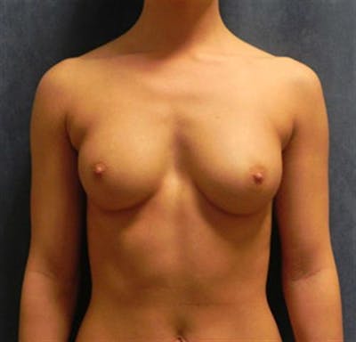 Breast Augmentation Before & After Gallery - Patient 289665 - Image 1