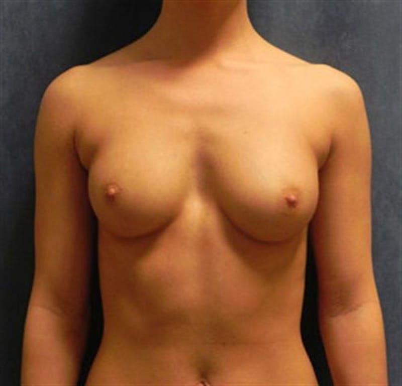 Breast Augmentation Before & After Gallery - Patient 289665 - Image 1