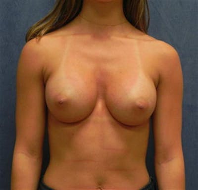 Breast Augmentation Before & After Gallery - Patient 289665 - Image 2