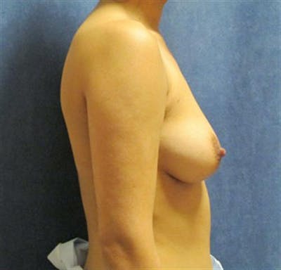 Breast Augmentation Before & After Gallery - Patient 454508 - Image 1