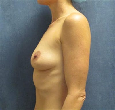 Breast Augmentation Before & After Gallery - Patient 373686 - Image 1